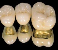 PFM, Porcelain Fused to Metal crown fabrication